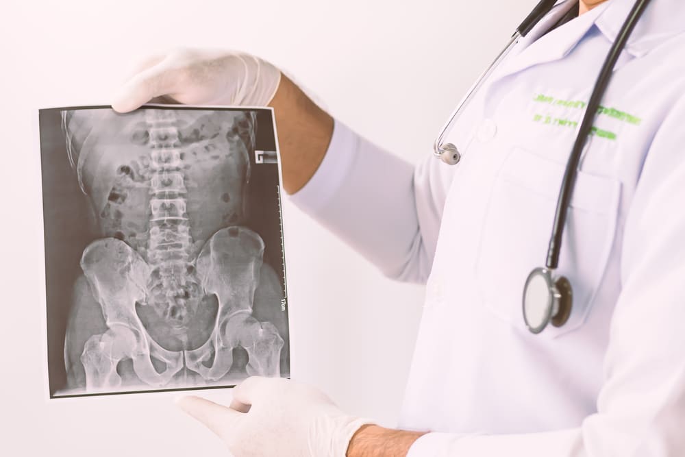 Diagnosticul spondilitei anchilozante